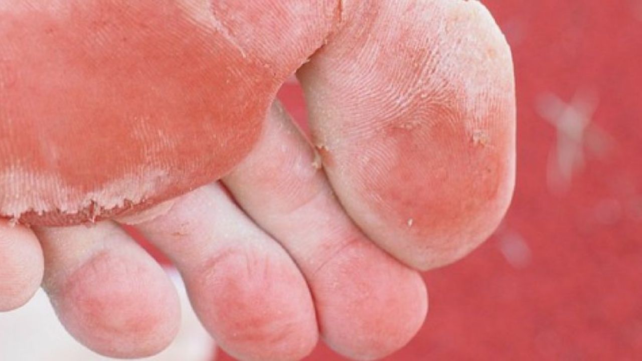 micosi cosa sono funghi della pelle