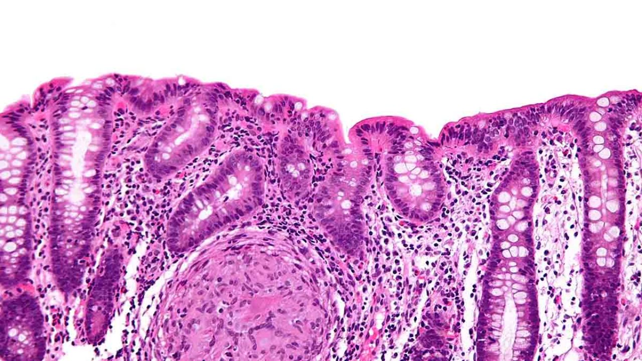 morbo di crohn alimentazione corretta