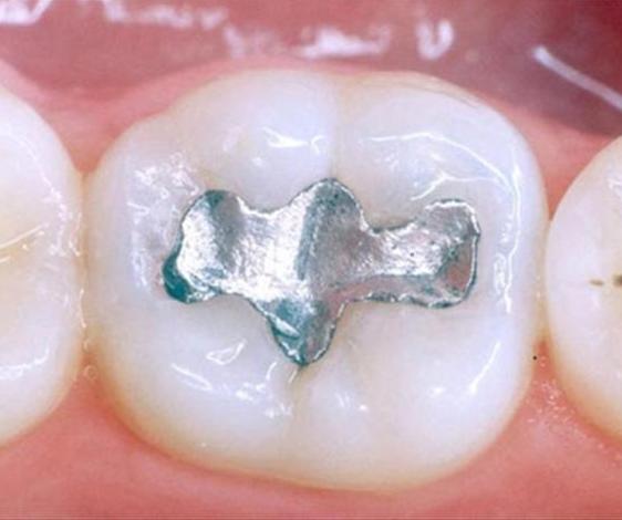 Otturazioni dentali e intossicazioni da mercurio: quali rischi