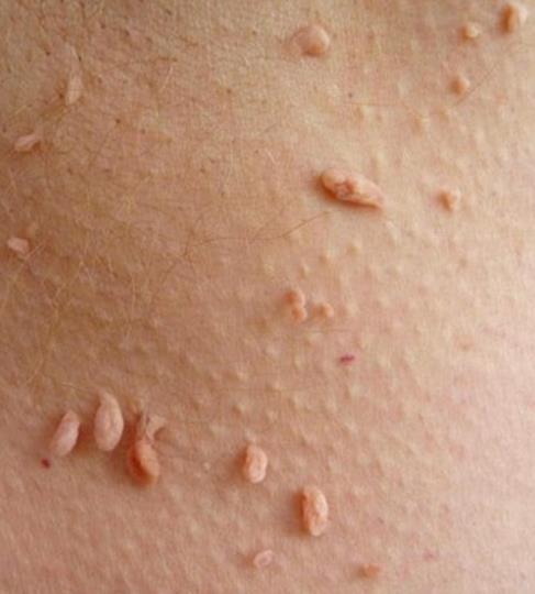 Come eliminare nei e fibromi penduli in modo naturale - Ambiente Bio