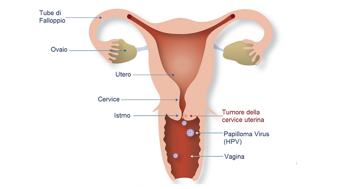 cos e il papilloma virus