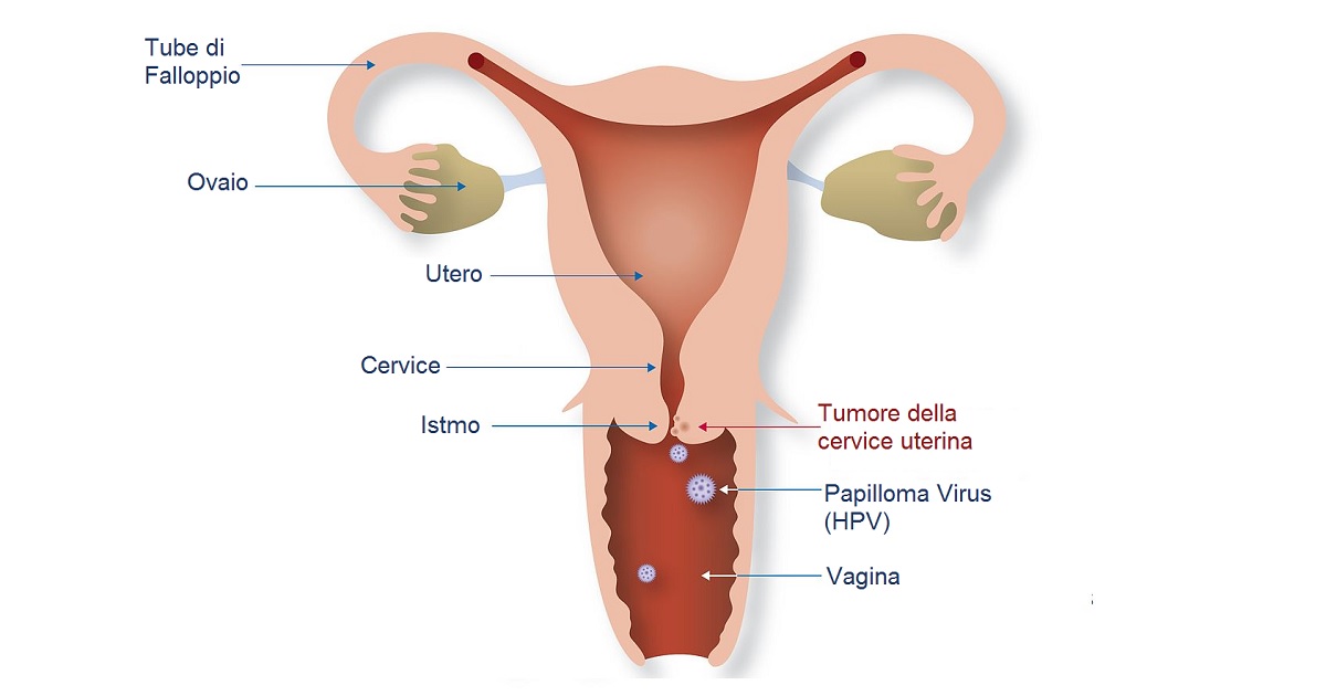 papilloma virus e lesioni)