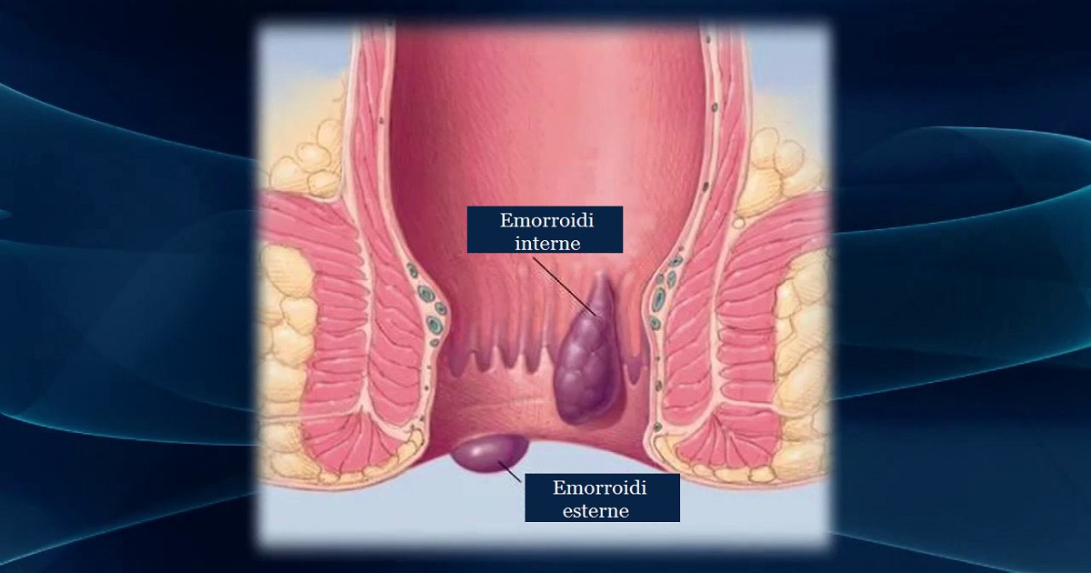 Emorroidi: sintomi, cause, rimedi