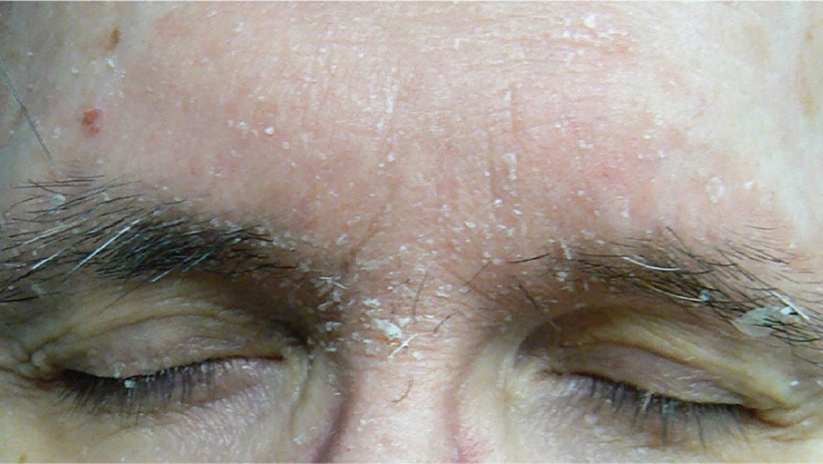 dermatite seborroica pelle occhi