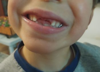 denti da latte