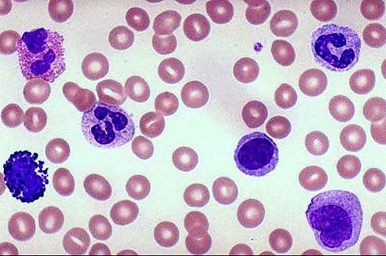 Leucociti nelle urine e globuli bianchi alti cause e rimedi Ambiente Bio